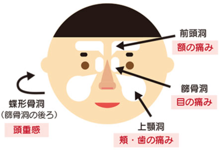 慢性副鼻腔炎の症状